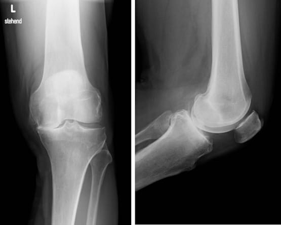 Die Arthrose des Kniegelenke